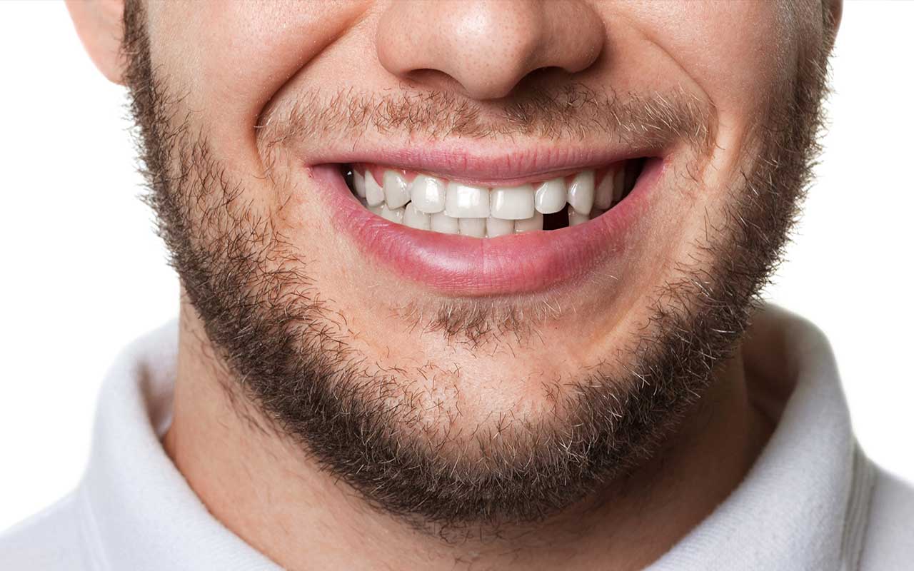 Missing teeth? How can I replace it?