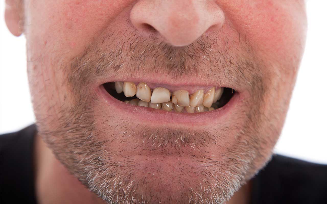 What do I do if I notice I have a cracked tooth?