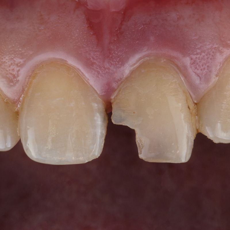 Close-up of a chipped front tooth