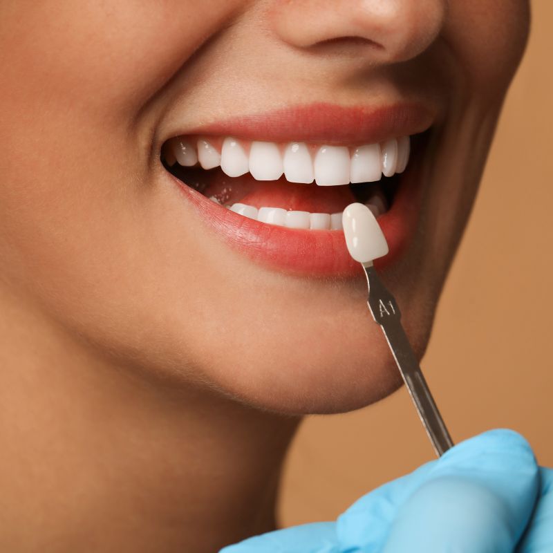 Veneers at Hillier Road Dental