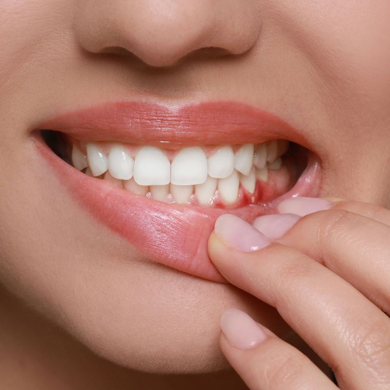 Gingivitis and gum disease at Hillier Road Dental