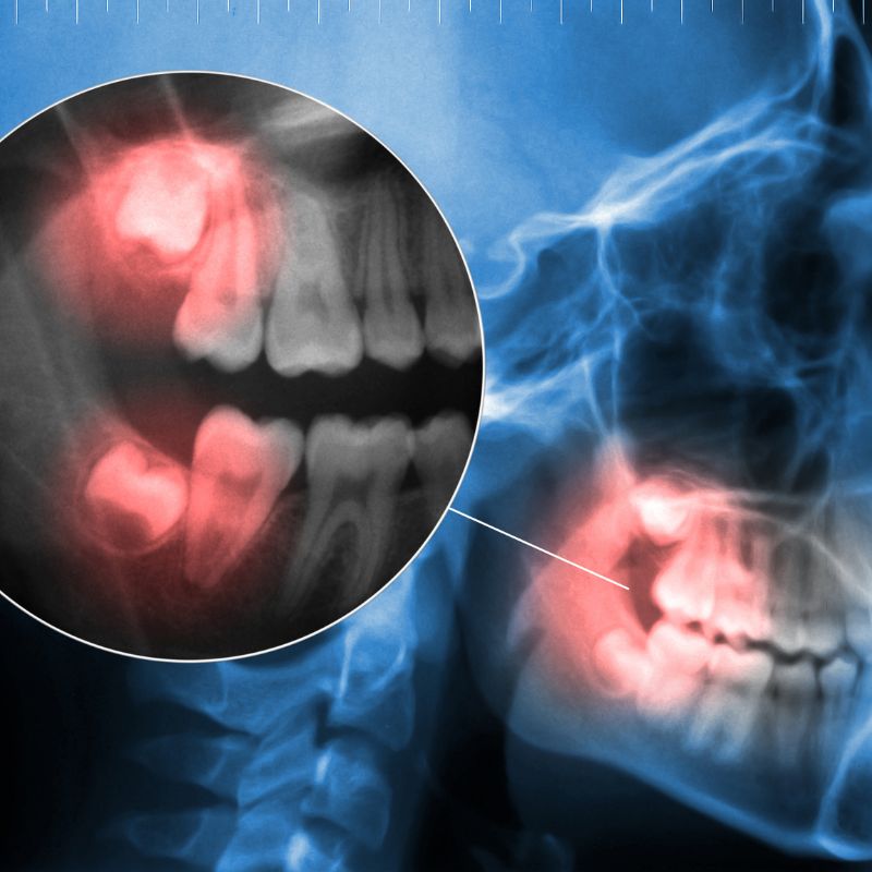 X-ray showing an impacted wisdom tooth