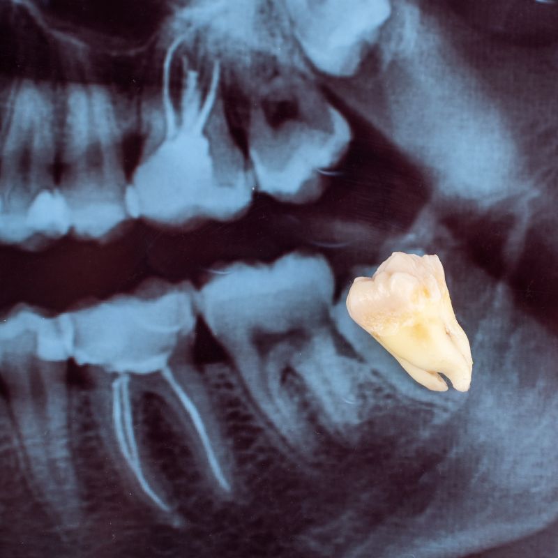 Wisdom Teeth at Hillier Road Dental
