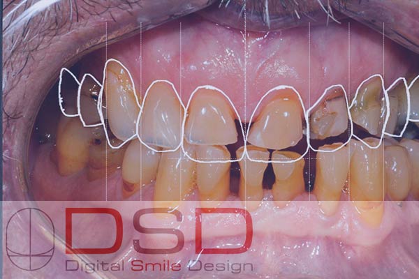 Digital Smile Design at Hillier Road Dental