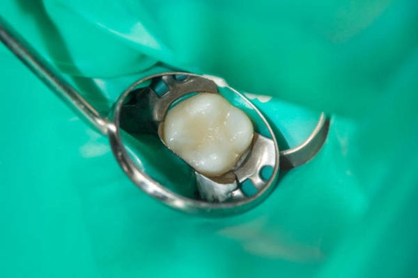 Rubber Dam at Hillier Road Dental