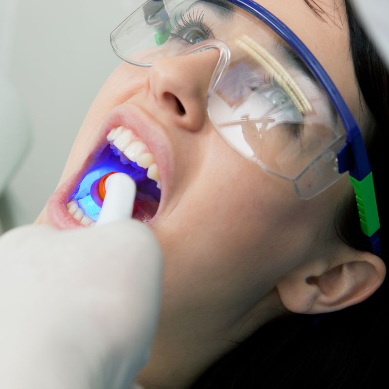 Fillings at Hillier Road Dental