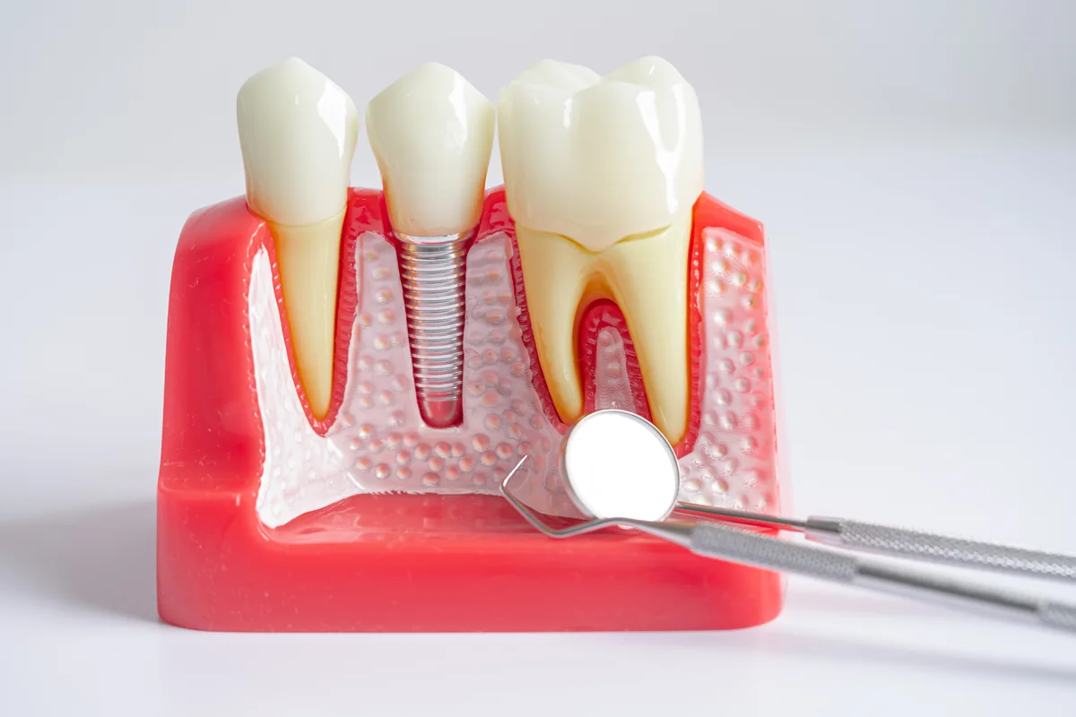 Implants and Replacements at Hillier Road Dental