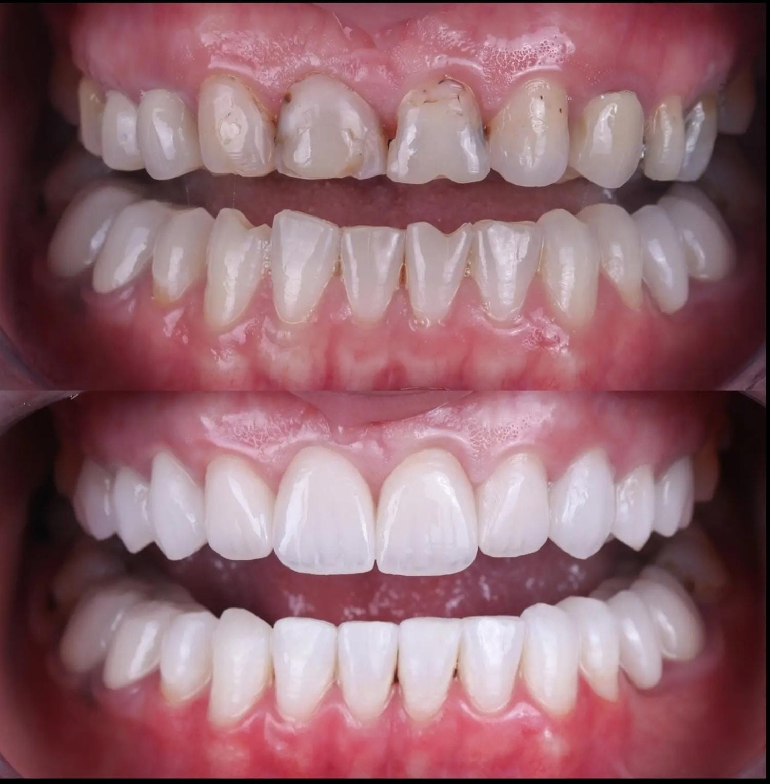 Patient smile transformation 1 at Hillier Road Dental