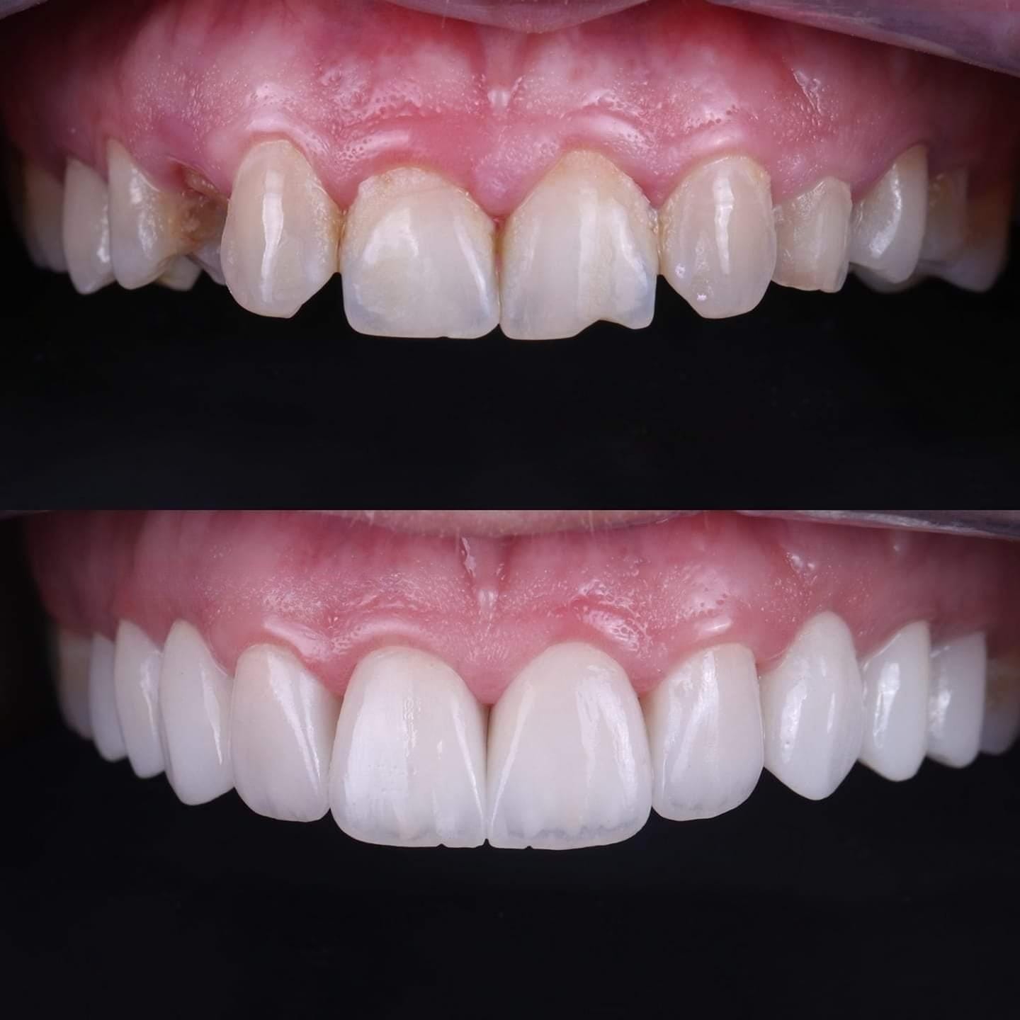 Patient smile transformation 2 at Hillier Road Dental