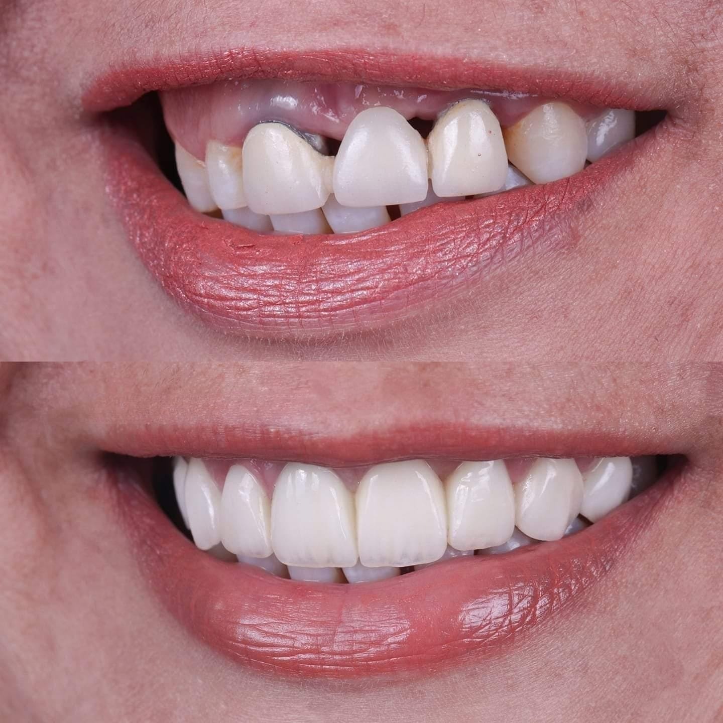 Patient smile transformation 3 at Hillier Road Dental