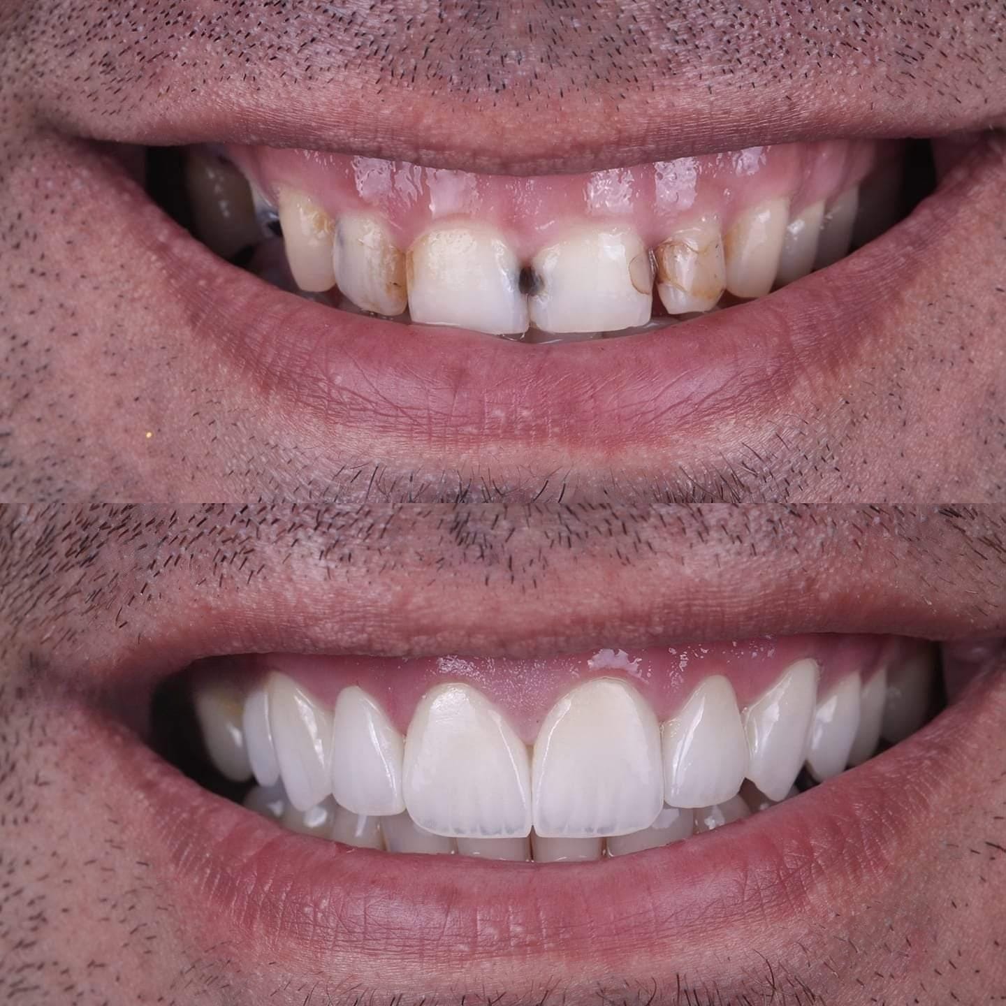 Patient smile transformation 4 at Hillier Road Dental