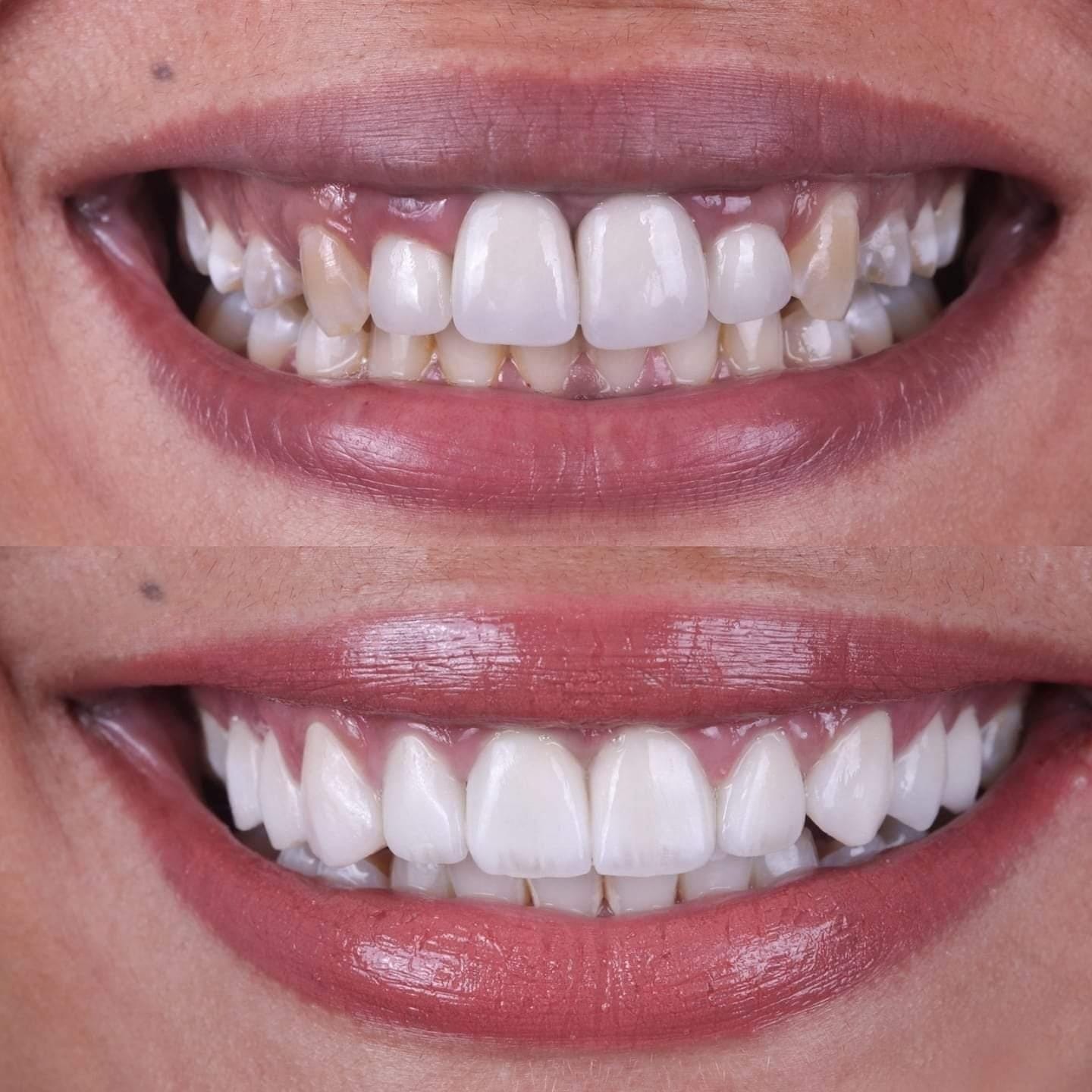Patient smile transformation 5 at Hillier Road Dental