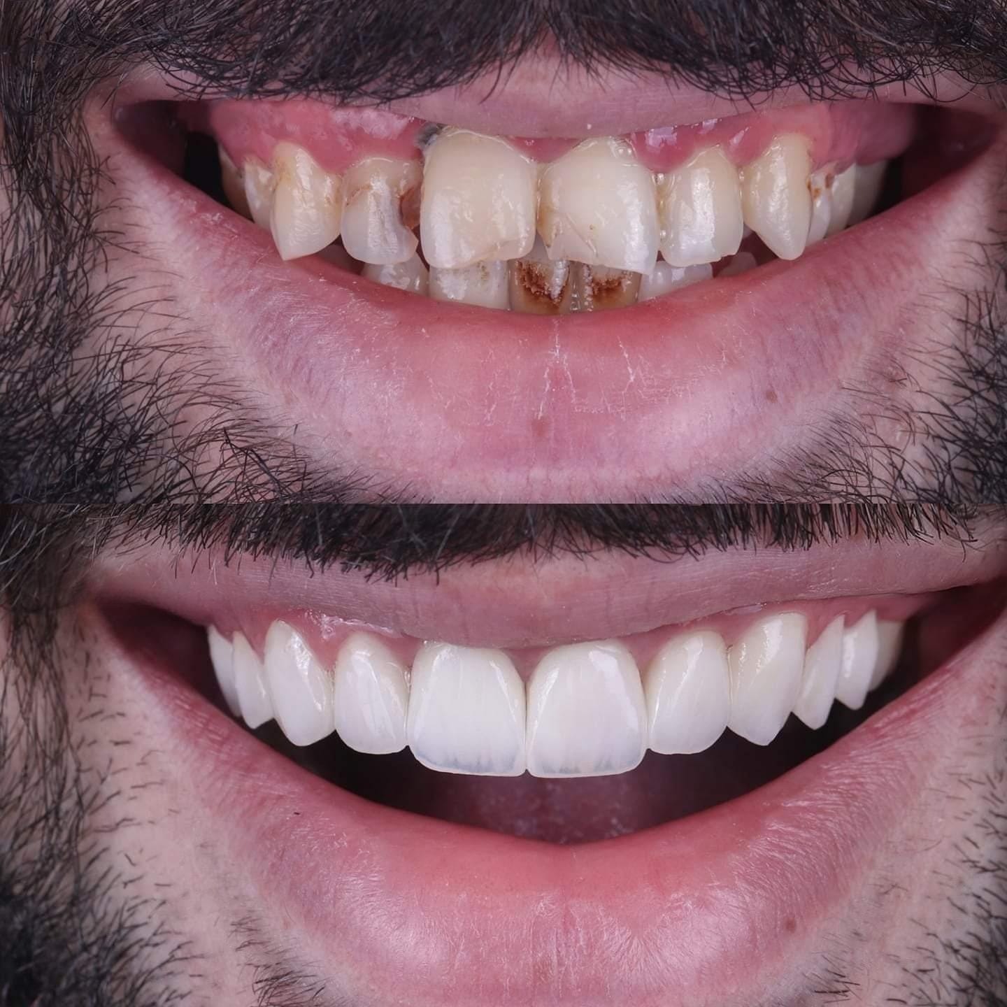 Patient smile transformation 6 at Hillier Road Dental