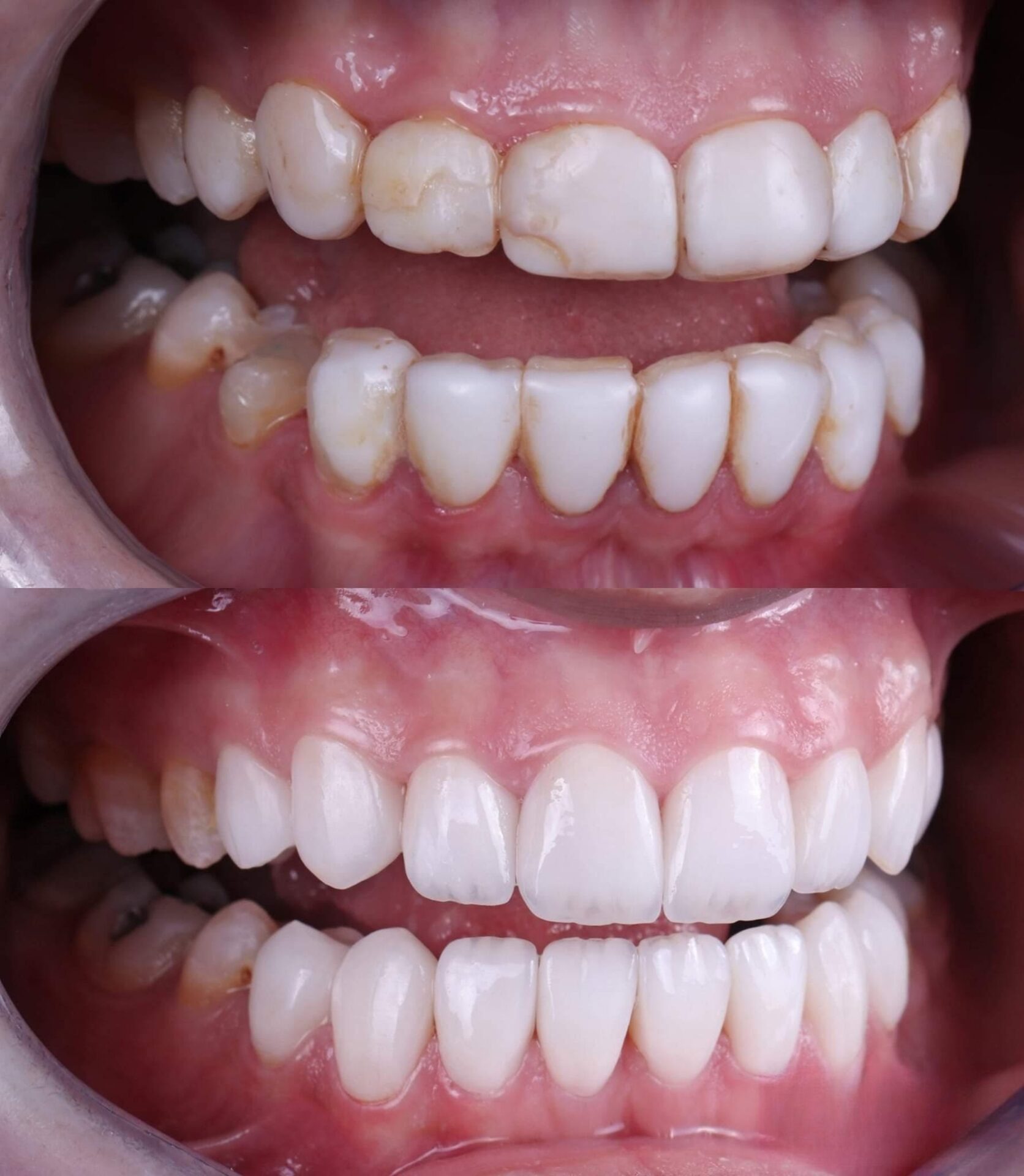Patient smile transformation 7 at Hillier Road Dental