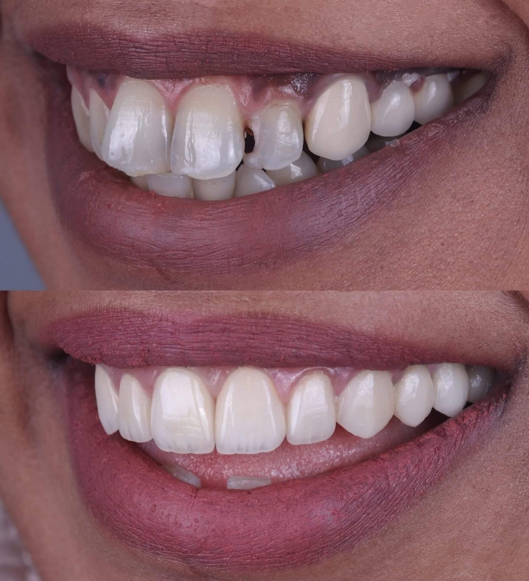 Patient smile transformation 8 at Hillier Road Dental