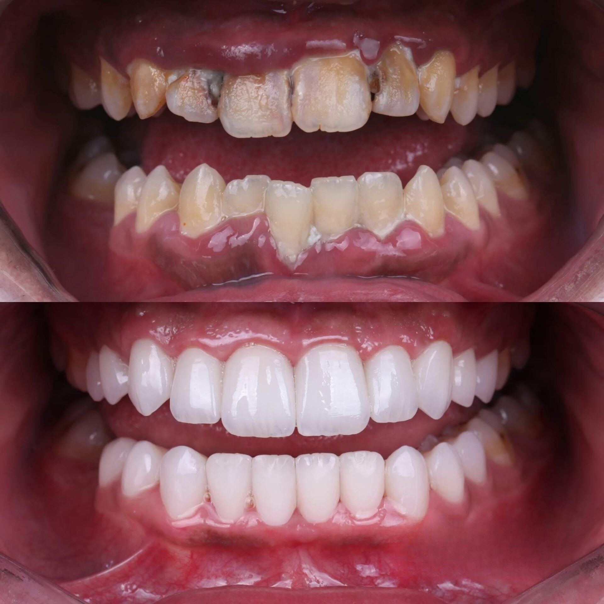 Patient smile transformation 9 at Hillier Road Dental
