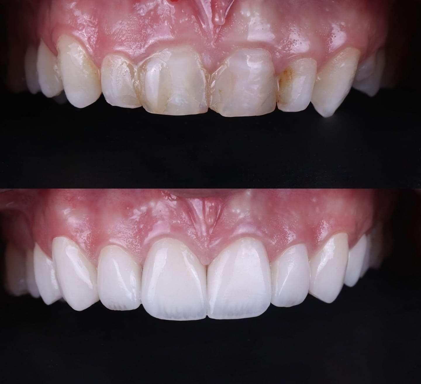 Patient smile transformation 10 at Hillier Road Dental