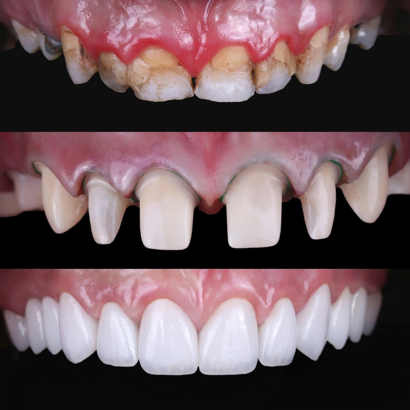 Patient smile transformation 11 at Hillier Road Dental