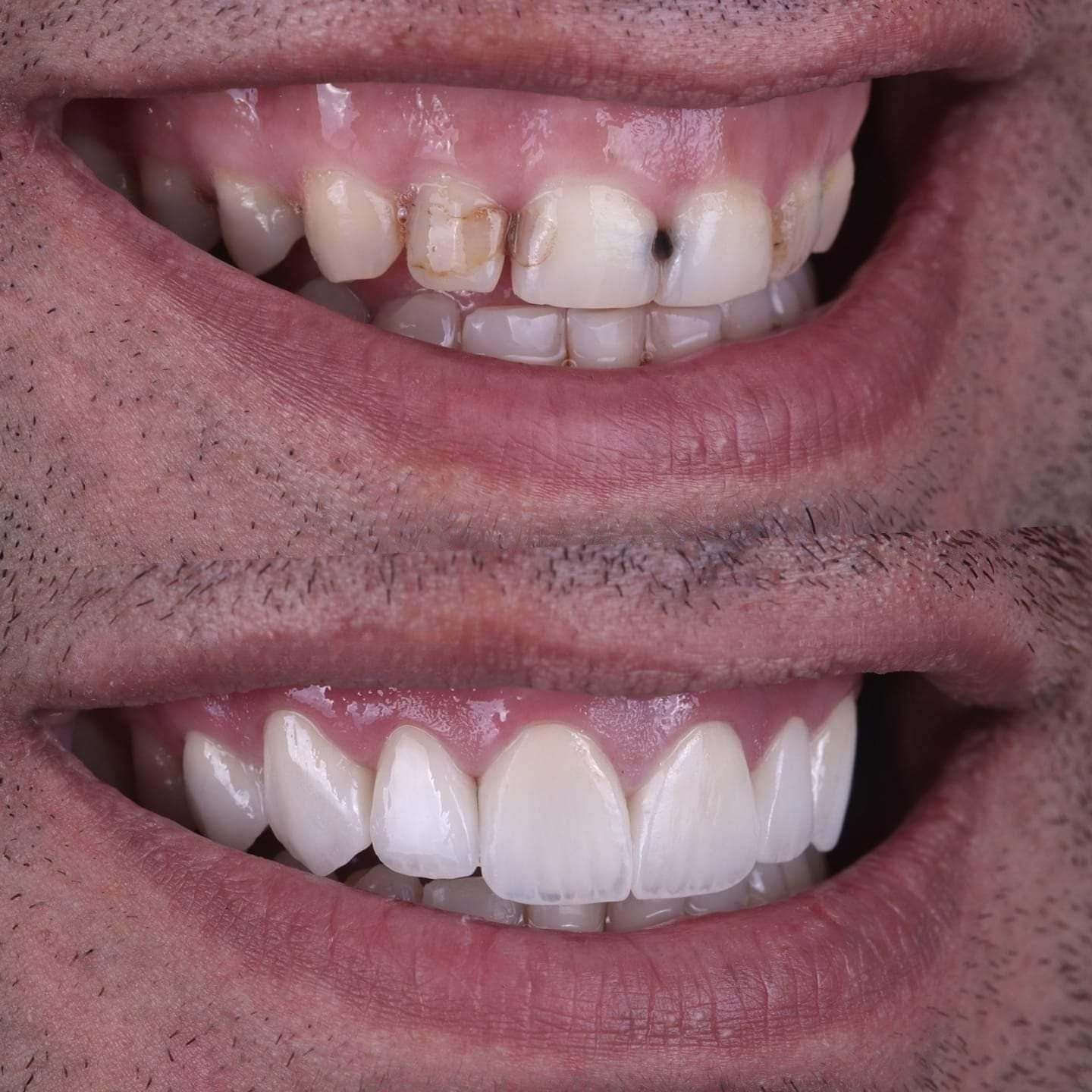 Patient smile transformation 12 at Hillier Road Dental