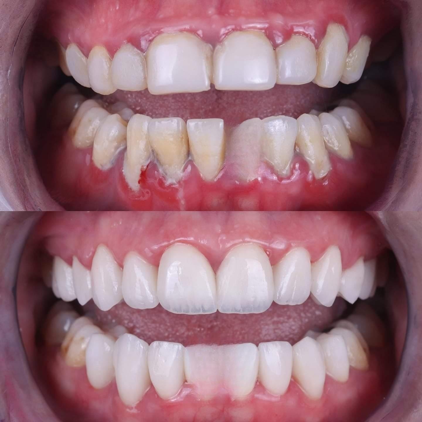 Patient smile transformation 13 at Hillier Road Dental