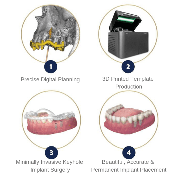 Guided Implant Process Using Replacedent